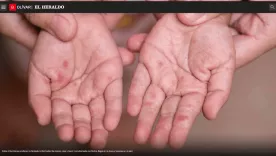 Afectación por virus Coxsackie o Enterovirus A71