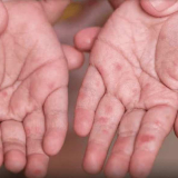 Afectación por virus Coxsackie o Enterovirus A71